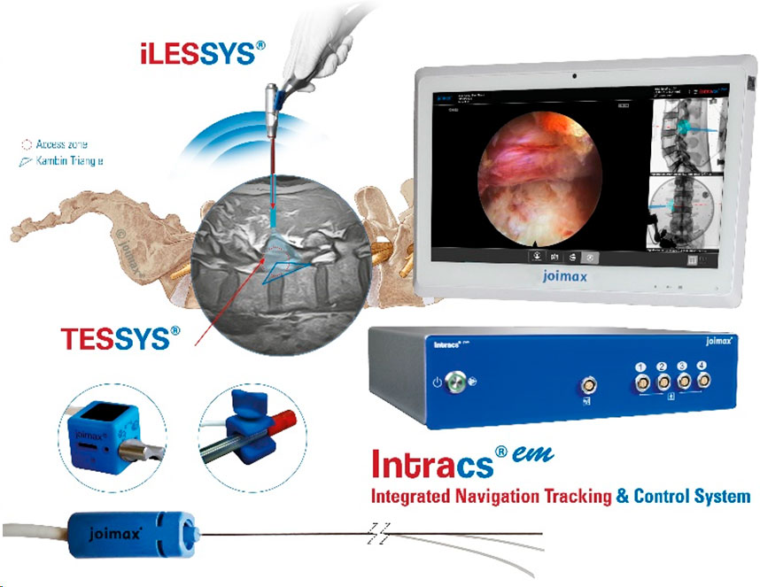 The Intracs®em electromagnetic navigation system is simple to set up, very user-friendly, and seamlessly integrates into the joimax® endoscopic tower. It allows for navigation during any endoscopic procedure performed with the joimax® endoscopic surgical systems, TESSYS® (transforaminal) and iLESSYS® (interlaminar). Beyond that, it can serve as a stand-alone device.