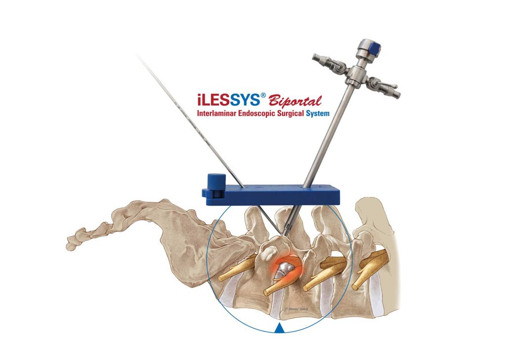 iLESSYS_Biportal illustration showing the biportal approach by joimax into the spine