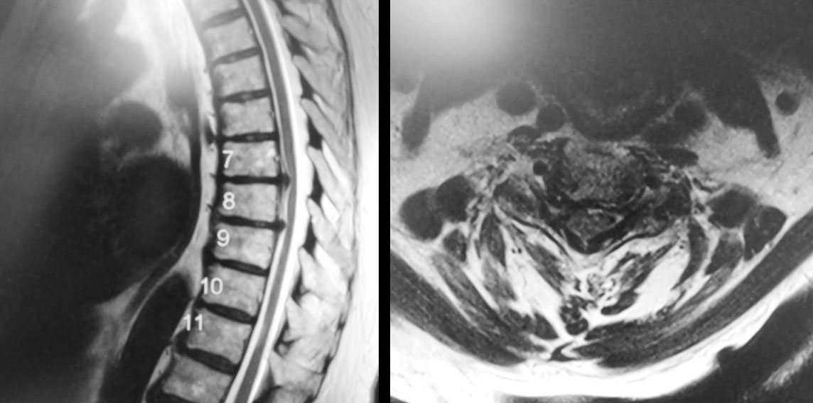 CESSYS-dorsal-mrt