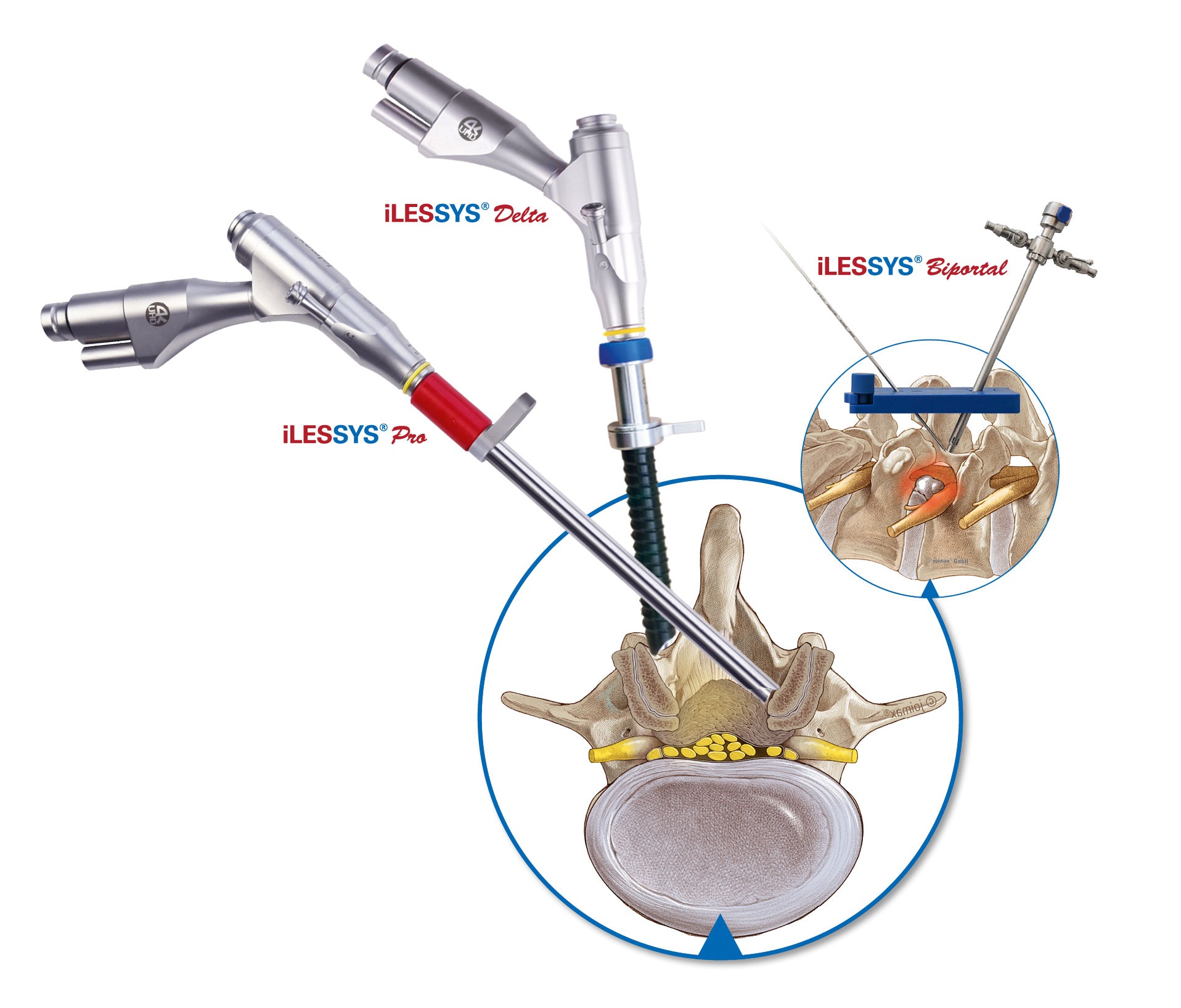 Interlaminar-surgery-systems