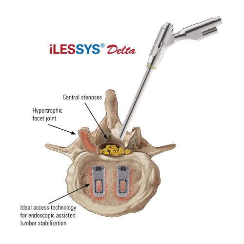 iLESSYS-Delta-Access