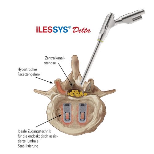 iLESSYS-Delta-Zugang