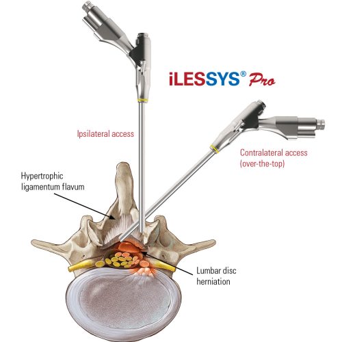 iLESSYS-Pro-Access