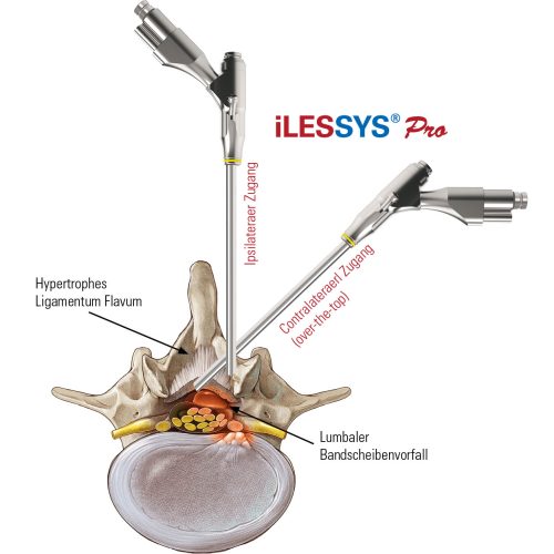 iLESSYS-Pro-Zugang