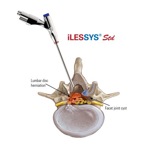 iLESSYS-Std-Access